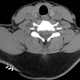 CT of the C-spine