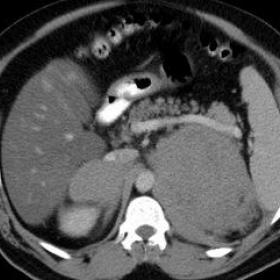 Case 1:  Abdomen and pelvis CT with oral and  IV contrast.
