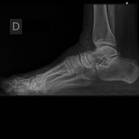 Lateral weight-bearing X-ray