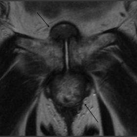 Coronal T2-weighted MRI