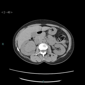 Plain CT of the abdomen