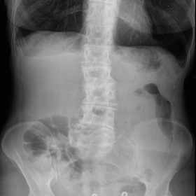 PA abdominal radiograph