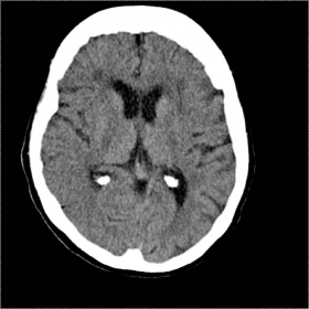 Unenhanced CT head axial view