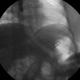 Fluoroscopy-guided endoscopic positioning of gastroesophageal stent
