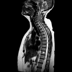 Sagittal T2 Cervicothoracic spine