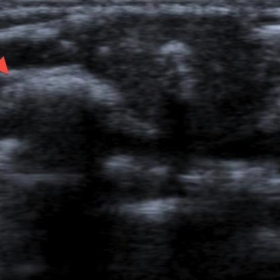 Ultrasound image of an intercostal space
