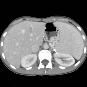 Initial contrast-enhanced multidetector CT at diagnosis