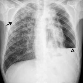 Chest X-ray PA (a) and lateral (b)