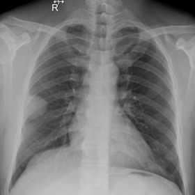 Chest radiograph (PA View)