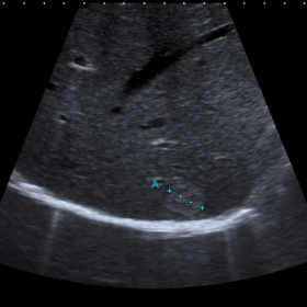 Patient A - Initial ultrasound