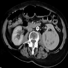 Axial image at the level of the left kidney