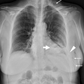 Antero-posterior (AP) and left-sided oblique chest radiographs for trauma