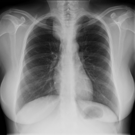 Chest X-ray PA (a) and lateral (b)