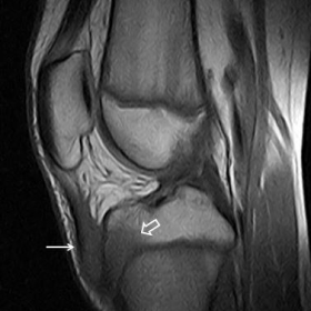 Sagittal T1-weighted image of the right knee