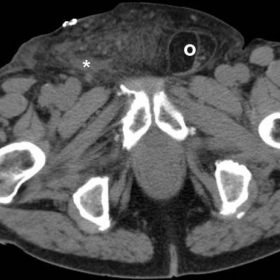 Urgent (same day) unenhanced and post contrast multidetector CT