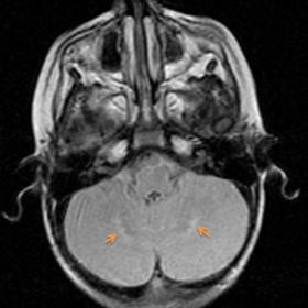 FLAIR-weighted MRI