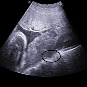 USG image showing loss of retroplacental clear space (within circle))