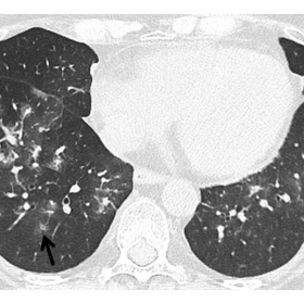 Non-enhanced chest CT