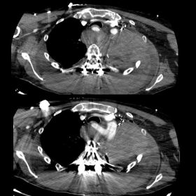 Axial views of contrast computed tomography of the thorax.