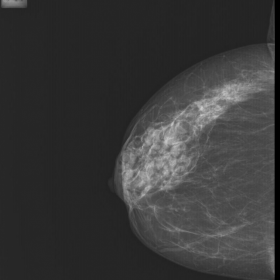 Right-side mammography