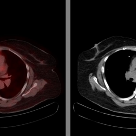 Post-treatment axial CT and PET-CT image of chest