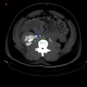 Axial reformatted contrast-enhanced CT MIP (maximum intensity projection) images