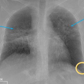 Chest radiograph PA view