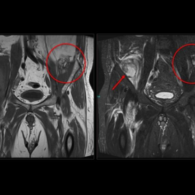 Coronal MR images of the pelvis