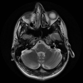 Axial T2W brain MRI