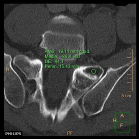 CT reformatted image of the sacrum.