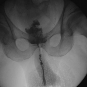 Fistulography demonstrating contrast filling pouch-like structure in the pelvis