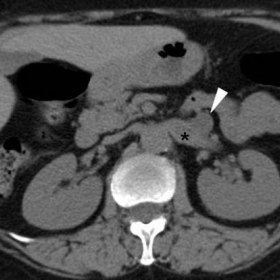 Initial unenhanced and post-contrast multidetector CT