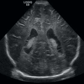 Axial head ultrasound