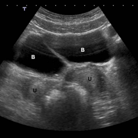 Transabdominal ultrasound image.