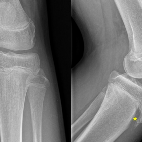 Plain radiograph of the left knee: Anteroposterior and Lateral view