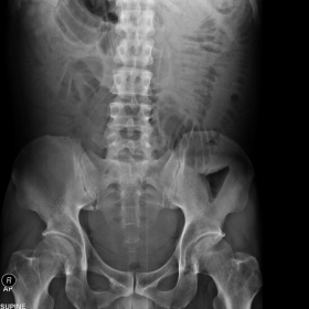 Plain x-ray upright and supine