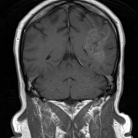 Gadolinium-enhanced T1 Coronal MRI