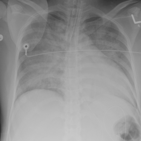 Portable chest x-ray frontal view