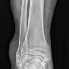 Anteroposterior view of right ankle