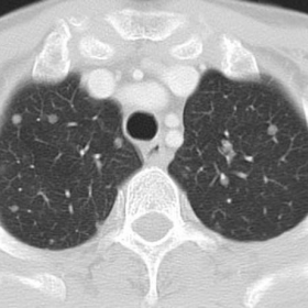Initial contrast-enhanced multidetector CT (thoracic images)