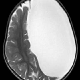 Axial T2W image