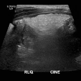Ultrasound abdomen
