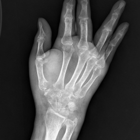 Posteroanterior view of right hand