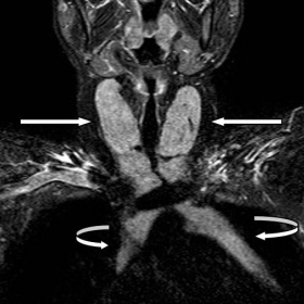MRI-STIR coronal