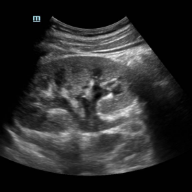Transabdominal ultrasound showing hydronephrosis and upper hydroureter.