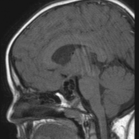 MRI Brain Plain