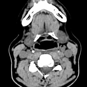Unenhanced Cervical Spine CT