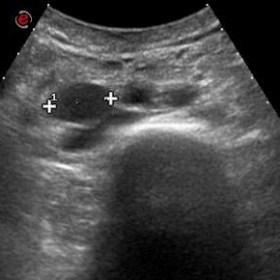 Initial ultrasound