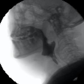 Swallowing study with barium contrast of the upper oesophagus