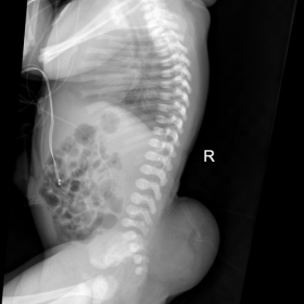 X-ray chest/abdomen